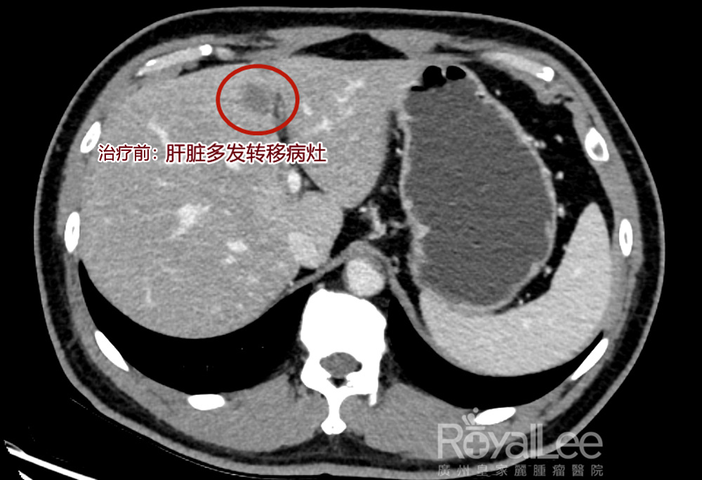 Before treatment: multiple metastases of the liver