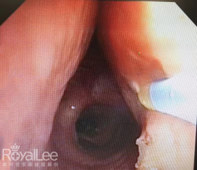 Tracheoesophageal Fistula Orifice on the Right Main Bronchus+ Biological Gel Filling Repair