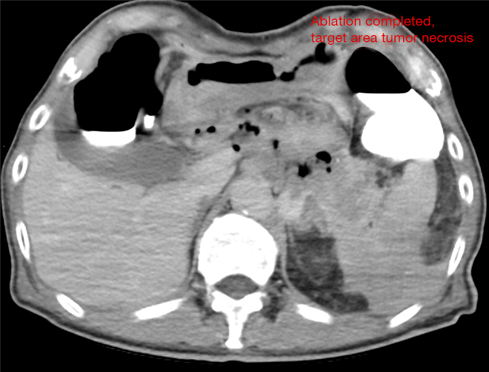 Ablation completed, target area tumor necrosis